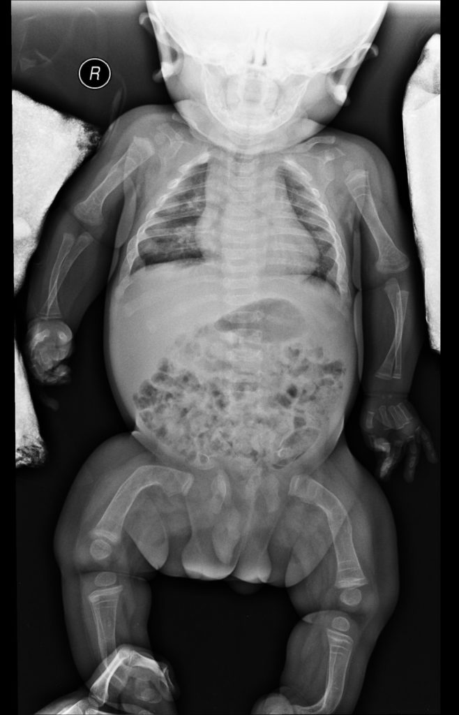 osteogenesis imperfecta